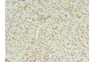 Immunohistochemistry of paraffin-embedded human breast cancer using ABIN7169003 at dilution of 1:100