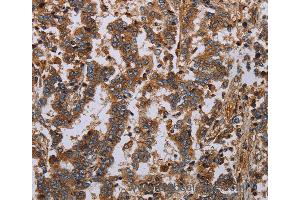 Immunohistochemistry of Human liver cancer using GDF2 Polyclonal Antibody at dilution of 1:40 (GDF2 抗体)