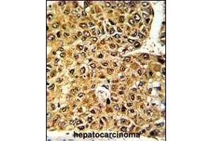 Formalin-fixed and paraffin-embedded human hepatocarcinoma with MLX Antibody (Center), which was peroxidase-conjugated to the secondary antibody, followed by DAB staining. (MLX 抗体  (AA 125-151))