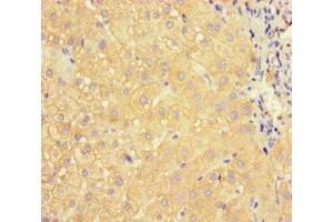 Immunohistochemistry of paraffin-embedded human liver cancer using ABIN7144419 at dilution of 1:100 (APOC3 抗体  (AA 21-99))