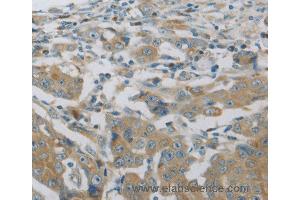 Immunohistochemistry of Human breast cancer using MAP2K6 Polyclonal Antibody at dilution of 1:30 (MAP2K6 抗体)