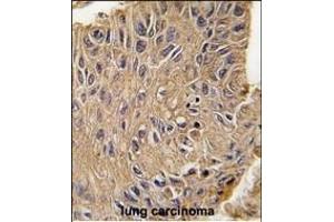 Formalin-fixed and paraffin-embedded human lung carcinoma tissue reacted with ANTXR1 Antibody  (ABIN392154 and ABIN2841879) , which was peroxidase-conjugated to the secondary antibody, followed by DAB staining.