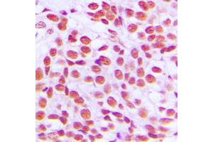 Immunohistochemical analysis of EGR1 staining in human breast cancer formalin fixed paraffin embedded tissue section. (EGR1 + EGR2 (C-Term) 抗体)