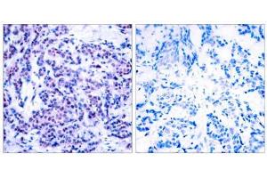 Immunohistochemical analysis of paraffin-embedded human breast carcinoma tissue using JunD (phospho- Ser255) antibody (E011028). (JunD 抗体  (pSer255))