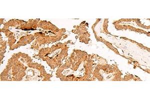 Immunohistochemistry of paraffin-embedded Human thyroid cancer tissue using POLR2L Polyclonal Antibody at dilution of 1:45(x200) (POLR2L 抗体)