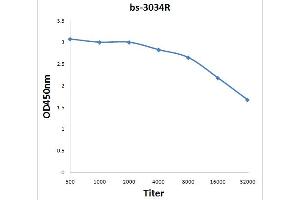 Formalin-fixed and paraffin embedded human bladder carcinoma labeled with Anti-Phospho-ATP1A1(Tyr10) Polyclonal Antibody, Unconjugated (ABIN683173) at 1:200 followed by conjugation to the secondary antibody and DAB staining.