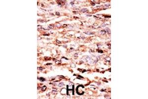 Formalin-fixed and paraffin-embedded human cancer tissue reacted with the primary antibody, which was peroxidase-conjugated to the secondary antibody, followed by AEC staining. (C-JUN 抗体  (pSer63))