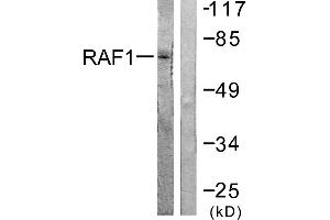Immunohistochemistry analysis of paraffin-embedded human lung carcinoma tissue using Raf1 (Ab-621) antibody. (RAF1 抗体  (Ser621))