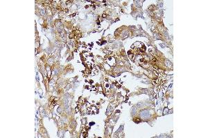 Immunohistochemistry of paraffin-embedded human lung cancer using CD52 antibody (ABIN7266207) at dilution of 1:100 (40x lens). (CD52 抗体  (AA 1-61))