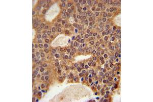DCLRE1B Antibody (Center) (ABIN651618 and ABIN2840328) immunohistochemistry analysis in formalin fixed and paraffin embedded human prostate carcinoma followed by peroxidase conjugation of the secondary antibody and DAB staining. (DCLRE1B 抗体  (AA 208-236))