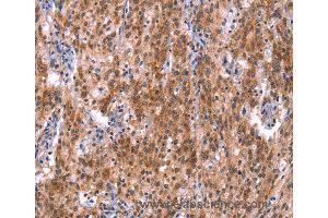 Immunohistochemistry of Human gastric cancer using GH1 Polyclonal Antibody at dilution of 1:40 (Growth Hormone 1 抗体)
