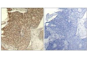 Immunohistochemical analysis of paraffin-embedded human breast carcinoma tissue using HDAC2(Phospho-Ser394) Antibody(left) or the same antibody preincubated with blocking peptide(right). (HDAC2 抗体  (pSer394))