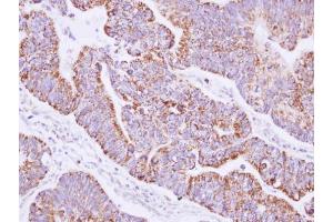 IHC-P Image Immunohistochemical analysis of paraffin-embedded human gastric cancer, using JIK, antibody at 1:100 dilution. (TAO Kinase 3 抗体)