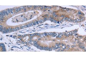 Immunohistochemistry of paraffin-embedded Human colon cancer using SLC1A6 Polyclonal Antibody at dilution of 1:40 (SLC1A6 抗体)