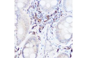 Immunohistochemistry of paraffin-embedded human colon carcinoma using Thromboxane synthase Rabbit pAb (ABIN6132172, ABIN6148915, ABIN6148917 and ABIN6219149) at dilution of 1:50 (40x lens). (TBXAS1 抗体  (AA 355-534))