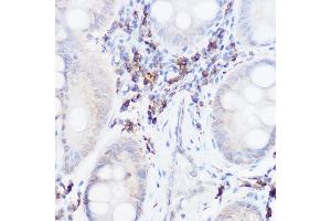 Immunohistochemistry of paraffin-embedded human colon carcinoma using Thromboxane synthase Rabbit pAb (ABIN6132172, ABIN6148915, ABIN6148917 and ABIN6219149) at dilution of 1:50 (40x lens). (TBXAS1 抗体  (AA 355-534))