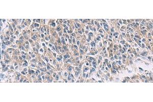 Immunohistochemistry of paraffin-embedded Human colorectal cancer tissue using PROKR2 Polyclonal Antibody at dilution of 1:40(x200) (Prokineticin Receptor 2 抗体)