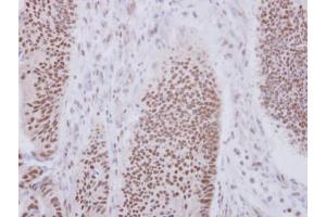 IHC-P Image Immunohistochemical analysis of paraffin-embedded human colon carcinoma, using XAB2, antibody at 1:250 dilution. (XAB2 抗体  (N-Term))