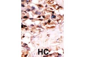 Formalin-fixed and paraffin-embedded human cancer tissue reacted with the primary antibody, which was peroxidase-conjugated to the secondary antibody, followed by DAB staining. (UCKL1 抗体  (N-Term))