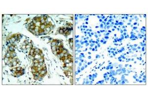 Immunohistochemical analysis of paraffin-embedded human breast carcinoma tissue using cdc25A(Phospho-Ser76) Antibody(left) or the same antibody preincubated with blocking peptide(right). (CDC25A 抗体  (pSer76))