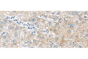 Immunohistochemistry of paraffin-embedded Human liver cancer tissue using NCOA4 Polyclonal Antibody at dilution of 1:130(x200) (NCOA4 抗体)