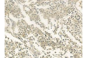 ABIN6260530 and ABIN6273206 at 1/100 staining human pituitary adenoma by IHC-P.