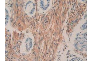 IHC-P analysis of Human Rectum Cancer Tissue, with DAB staining. (CD90 抗体  (AA 20-133))
