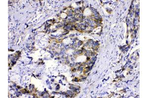 MUT was detected in paraffin-embedded sections of human intetsinal cancer tissues using rabbit anti- MUT Antigen Affinity purified polyclonal antibody (Catalog # ) at 1 µg/mL. (MUT 抗体  (N-Term))