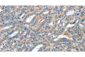 Immunohistochemistry of paraffin-embedded Human thyroid cancer tissue using ANGPT1 Polyclonal Antibody at dilution 1:50 (Angiopoietin 1 抗体)