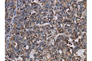 The image on the left is immunohistochemistry of paraffin-embedded Human ovarian cancer tissue using ABIN7130066(LBR Antibody) at dilution 1/50, on the right is treated with fusion protein. (Lamin B Receptor 抗体)
