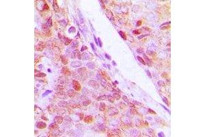 Immunohistochemical analysis of RPL5 staining in human breast cancer formalin fixed paraffin embedded tissue section. (RPL5 抗体)