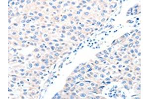 The image on the left is immunohistochemistry of paraffin-embedded Human breast cancer tissue using ABIN7128234(ADAM32 Antibody) at dilution 1/15, on the right is treated with fusion protein. (ADAM32 抗体)