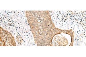Immunohistochemistry of paraffin-embedded Human esophagus cancer tissue using TOR1A Polyclonal Antibody at dilution of 1:35(x200) (TOR1A 抗体)