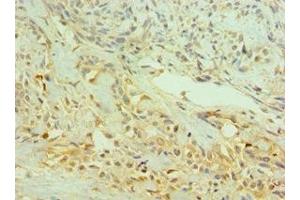 Immunohistochemistry of paraffin-embedded human breast cancer using ABIN7145333 at dilution of 1:100 (TRKB 抗体  (AA 32-282))