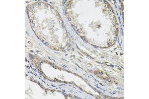Immunohistochemistry of paraffin-embedded human prostate cancer using UBE2S antibody. (UBE2S 抗体  (AA 122-221))