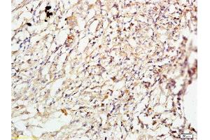 Formalin-fixed and paraffin embedded human lung carcinoma labeled with Anti-ROCK1 Polyclonal Antibody, Unconjugated  at 1:200 followed by conjugation to the secondary antibody and DAB staining. (ROCK1 抗体  (AA 1001-1200))