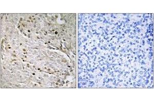 Immunohistochemistry analysis of paraffin-embedded human prostate carcinoma, using POTE8 Antibody. (POTEA 抗体  (AA 375-424))