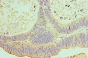 Immunohistochemistry of paraffin-embedded human colon cancer using ABIN7156853 at dilution of 1:100 (IL-22 抗体  (AA 34-179))
