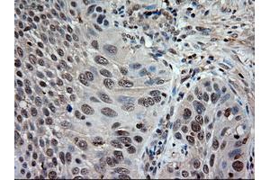 Immunohistochemical staining of paraffin-embedded Adenocarcinoma of colon using anti-NTF3 (ABIN2452683) mouse monoclonal antibody. (Neurotrophin 3 抗体  (AA 139-257))