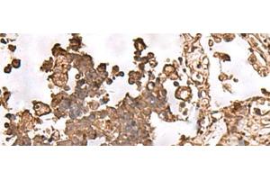 Immunohistochemistry of paraffin-embedded Human lung cancer tissue using FAAP24 Polyclonal Antibody at dilution of 1:30(x200) (FAAP24 抗体)