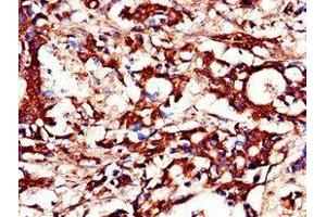 Immunohistochemistry of paraffin-embedded human gastric cancer using ABIN7150756 at dilution of 1:100 (DUSP19 抗体  (AA 1-217))