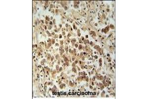 VCX1 Antibody (N-term) (ABIN654781 and ABIN2844462) immunohistochemistry analysis in formalin fixed and paraffin embedded human testis carcinoma followed by peroxidase conjugation of the secondary antibody and DAB staining. (VCX 抗体  (N-Term))