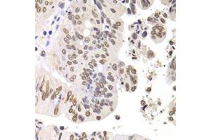 Immunohistochemistry of paraffin-embedded human colon carcinoma using SOX5 antibody. (SOX5 抗体  (AA 1-120))