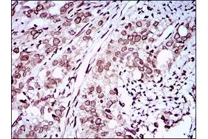 Immunohistochemical analysis of paraffin-embedded cervical cancer tissues using ZEB1 mouse mAb with DAB staining. (ZEB1 抗体  (AA 967-1108))