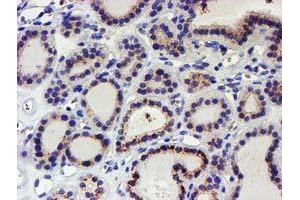 Immunohistochemical staining of paraffin-embedded Carcinoma of Human thyroid tissue using anti-KCNAB1 mouse monoclonal antibody. (KCNAB1 抗体)