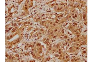 IHC image of ABIN7139904 diluted at 1:100 and staining in paraffin-embedded human liver cancer performed on a Leica BondTM system. (AJUBA 抗体  (AA 61-77))