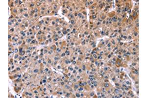 The image on the left is immunohistochemistry of paraffin-embedded Human liver cancer tissue using ABIN7128938(CHRM1 Antibody) at dilution 1/20, on the right is treated with fusion protein. (CHRM1 抗体)