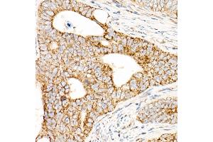 Immunohistochemistry of paraffin-embedded human colon carcinoma using L2 Rabbit pAb (ABIN7265513) at dilution of 1:50 (40x lens). (AFG3L2 抗体  (AA 538-797))
