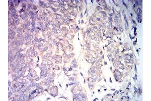Immunohistochemical analysis of paraffin-embedded bladder cancer tissues using BAX mouse mAb with DAB staining. (BAX 抗体)