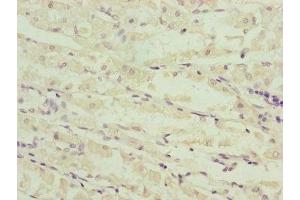Immunohistochemistry of paraffin-embedded human gastric cancer using ABIN7160967 at dilution of 1:100 (NDUFS6 抗体  (AA 29-124))